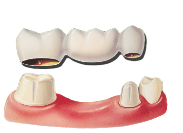 dental-bridges.gif